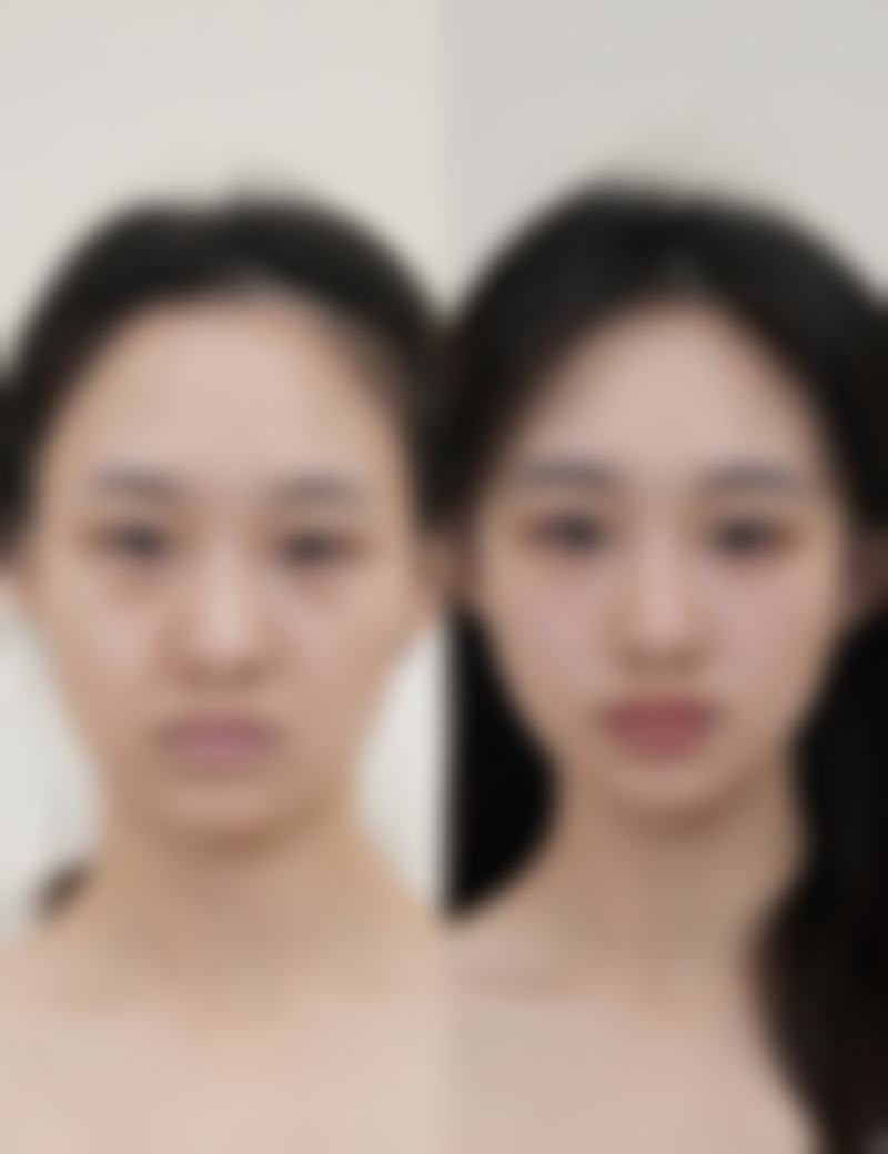 隆鼻修复期有多久——自体软骨隆鼻：1 - 3个月的“自然派”