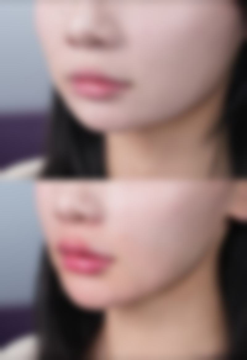 隆鼻修复期有多久——注射隆鼻：1 - 2周修复的“午休美容”