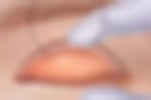 全切双眼皮非恒久的自然衰老因素