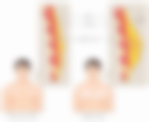 全切双眼皮恒久与非恒久的区别对比