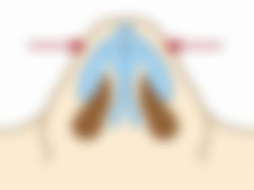 全切双眼皮是不是永久？揭秘永久效果的关键因素与维持时间