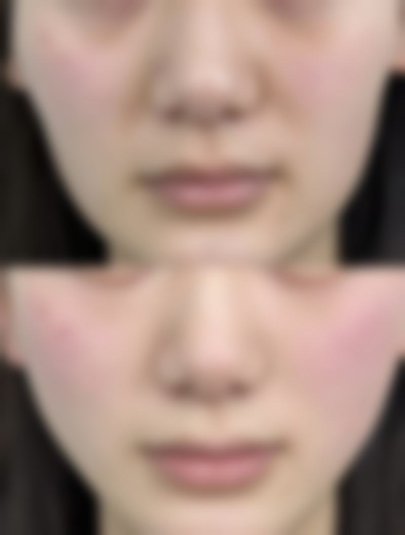 全切双眼皮非恒久的特殊体质因素