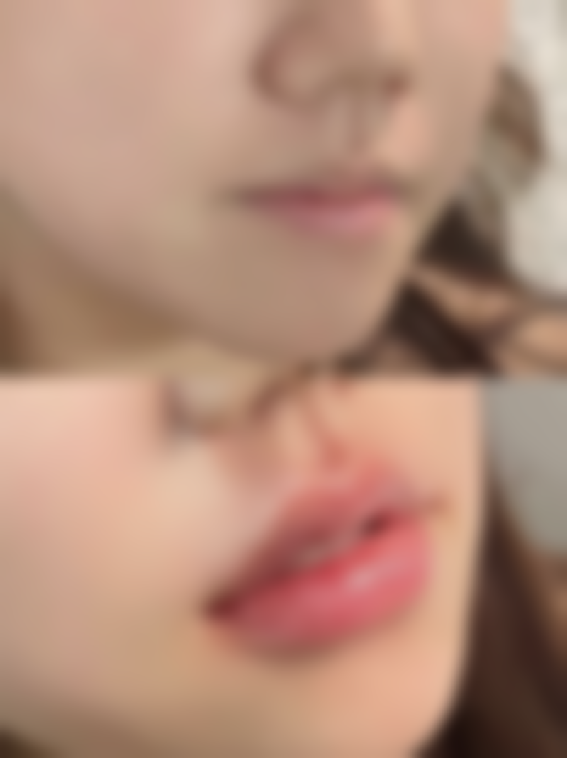 全切双眼皮恒久的判断方法解析