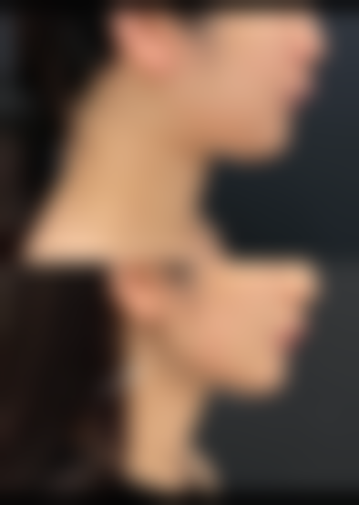 如何让全切双眼皮更恒久的术中配合