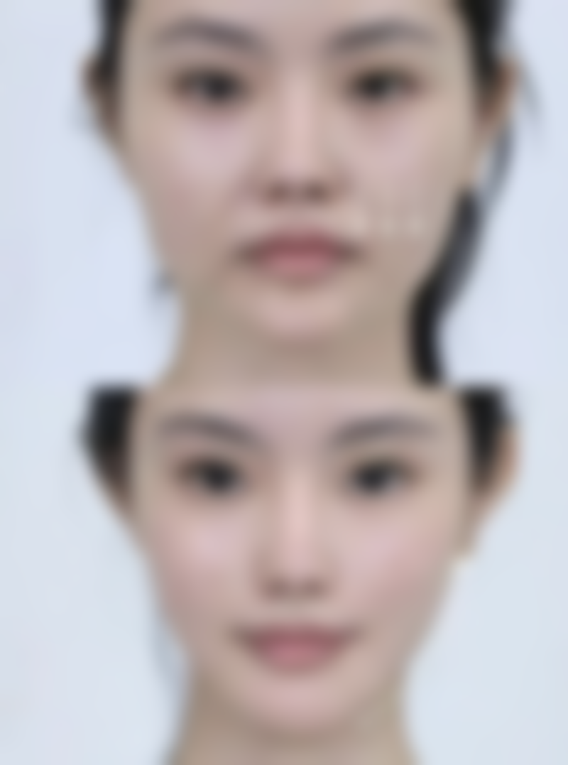 耳软骨隆鼻缺点有哪些——成效维持时间短，美丽需要“续费”