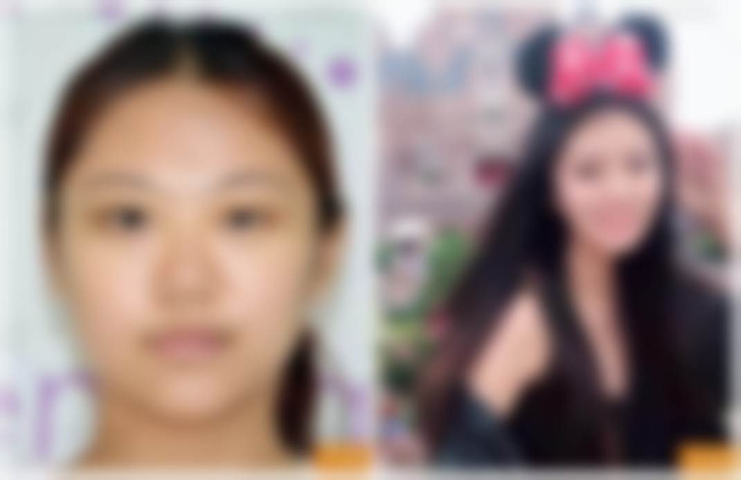 北京禾美嘉医疗美容门诊部余班林真实实例见证美丽奇迹