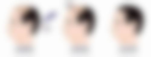 一次除皱针能维持多久：延长除皱针成效的“保鲜秘籍”