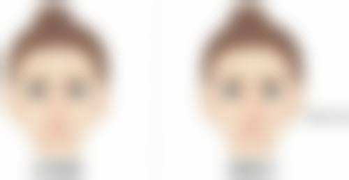 肋骨隆鼻管一辈子吗？安心性考量