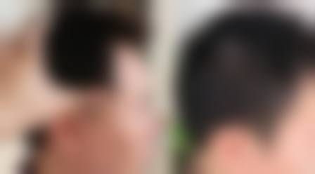 南通英莎医疗美容门诊部李辉医生真实患者评价