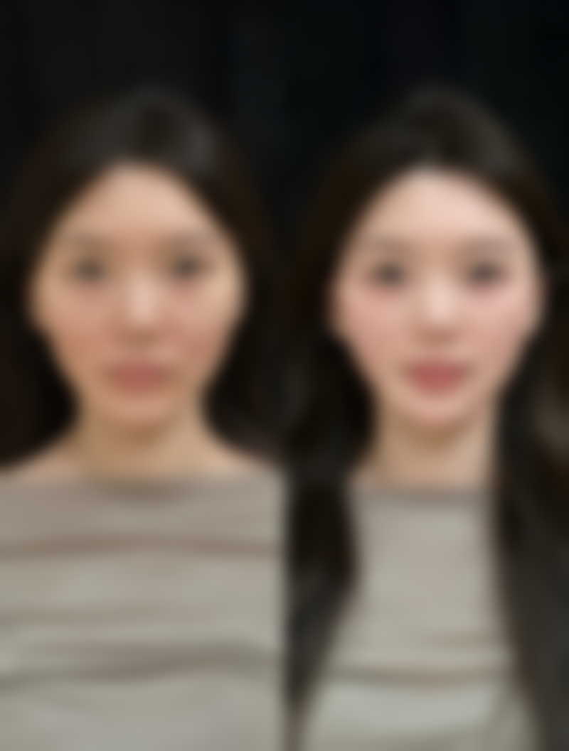 肋骨隆鼻管一辈子吗？效果持久但需注意护理，安全性与稳定性全解析