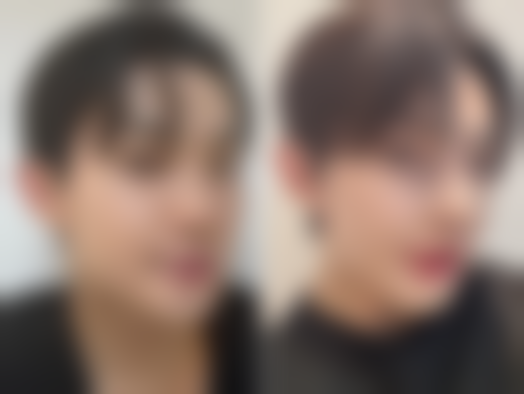 浅二度烫伤留下的疤痕会消掉吗？3个月淡化不是梦