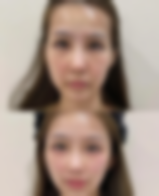 肋骨隆鼻管一辈子吗？终身护理指南