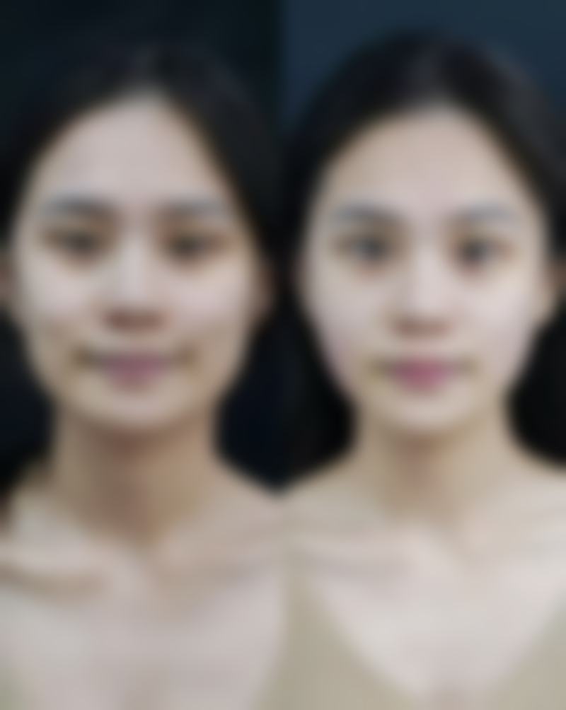 烫伤早期护理：预防疤痕的至佳时机