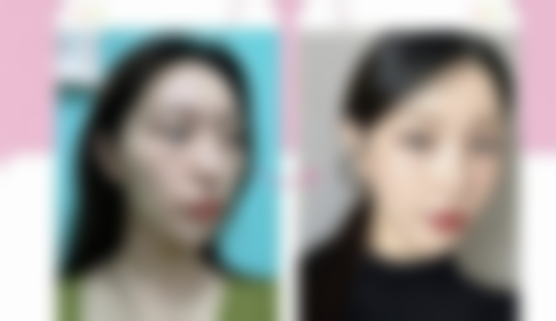 三等甲医院抽脂去眼袋的隐藏优势