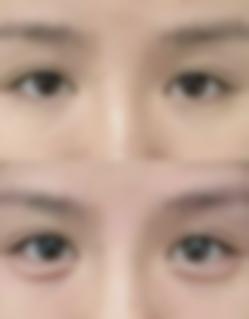 涂抹玻尿酸能丰太阳穴吗：注射与涂抹的天壤之别