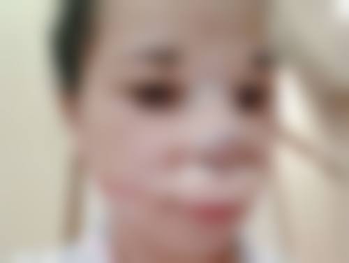 上海滩祛疤名院哪家强——摔伤疤痕色素沉着能祛除吗之魔都寻方