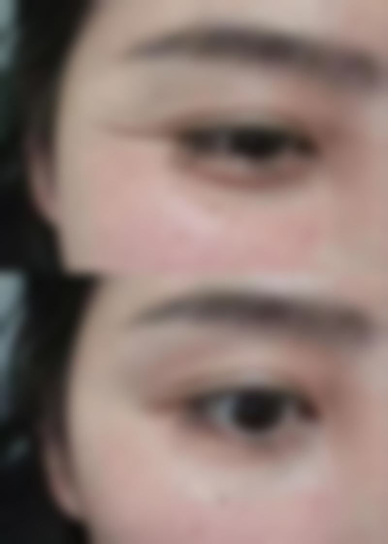 南通英莎医疗美容门诊部李辉做过的真实反馈——南通南京医科大学友谊整形外科医院南通医疗美容门诊部