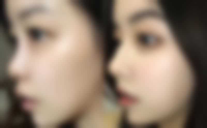 疤痕疙瘩怎么治疗能去根:放射治疗的神奇成效