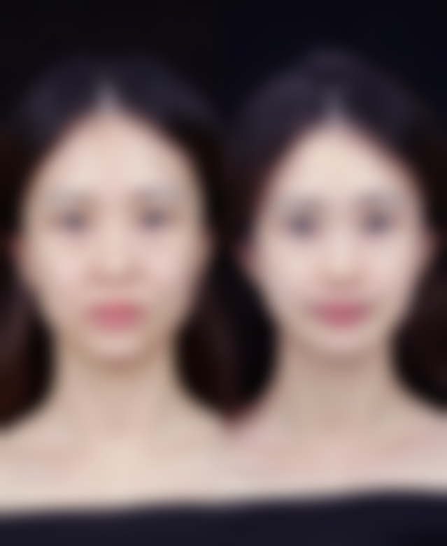 其他辅助治疗与生活建议:配合医院治疗消除开水烫伤疤痕