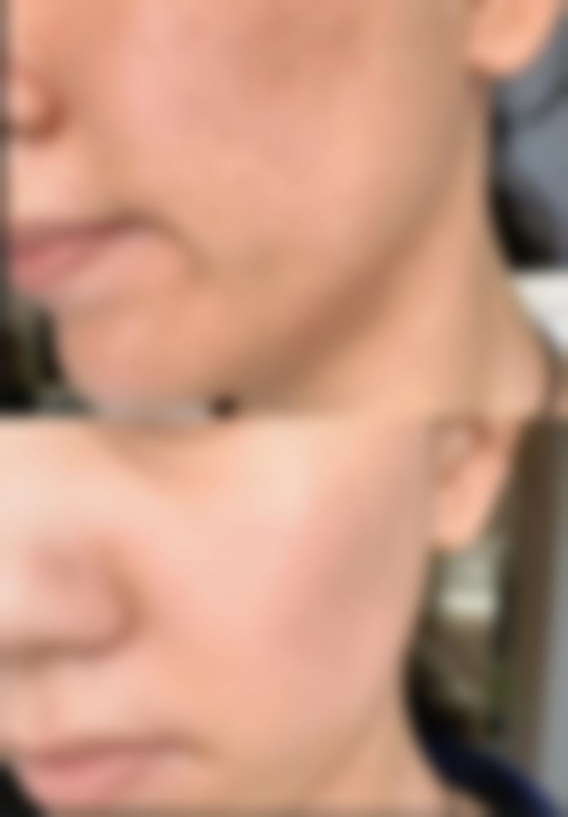 去眼袋有哪些风险——成效不理想风险：理性期待沟通，收获满意成效