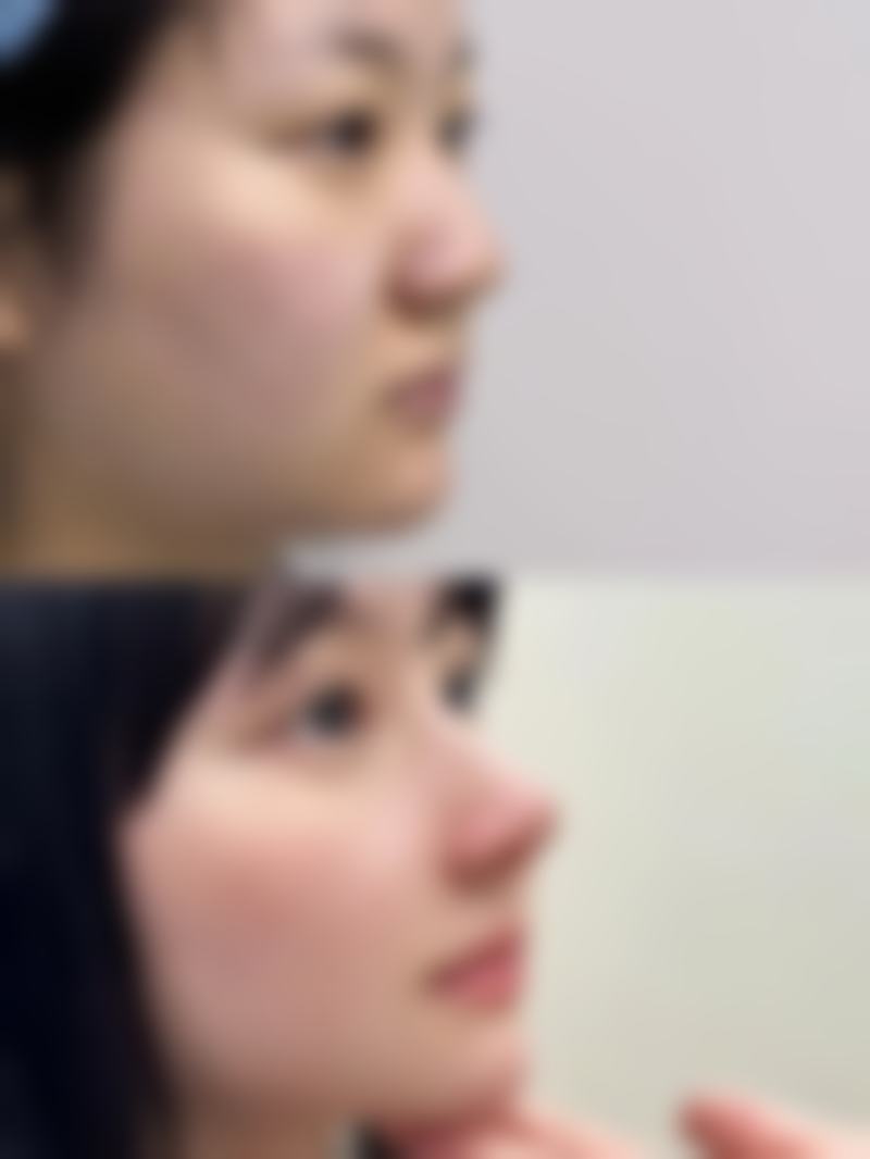 割双眼皮能吃平菇吗？温和派的“通行证”