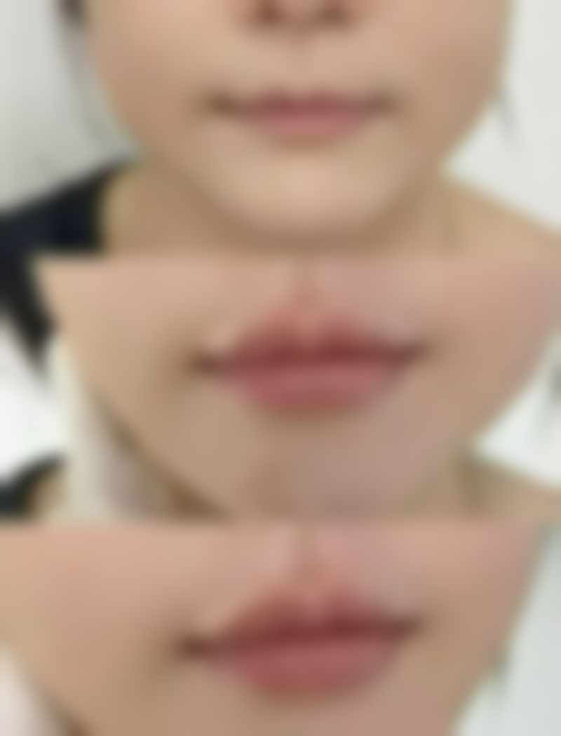 割双眼皮能吃香菇吗？争议背后的真相