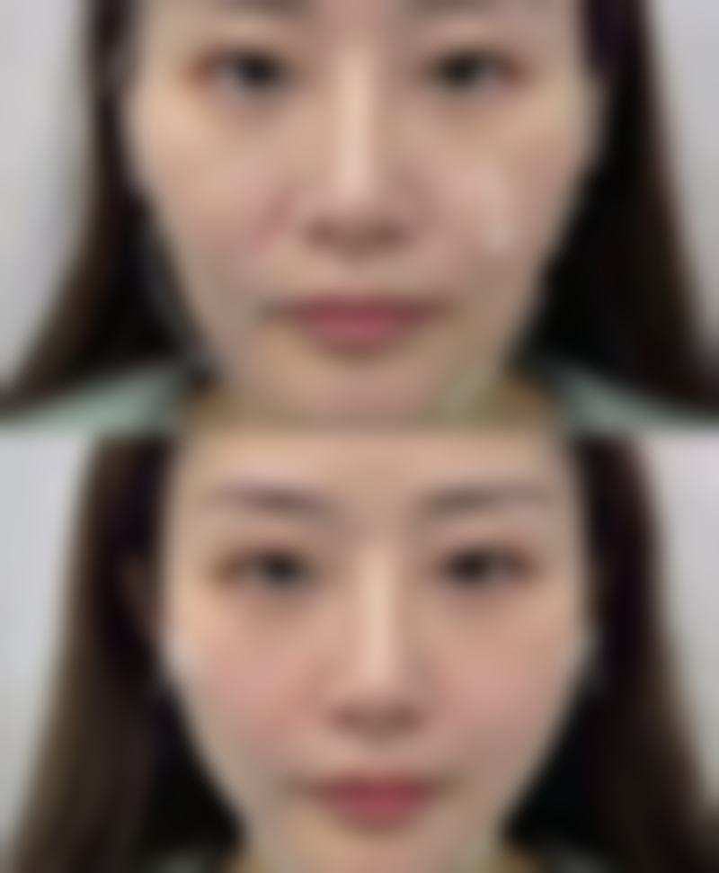 瘦脸针一般多少个单位？咬肌注射30-70单位，不同品牌剂量大揭秘！