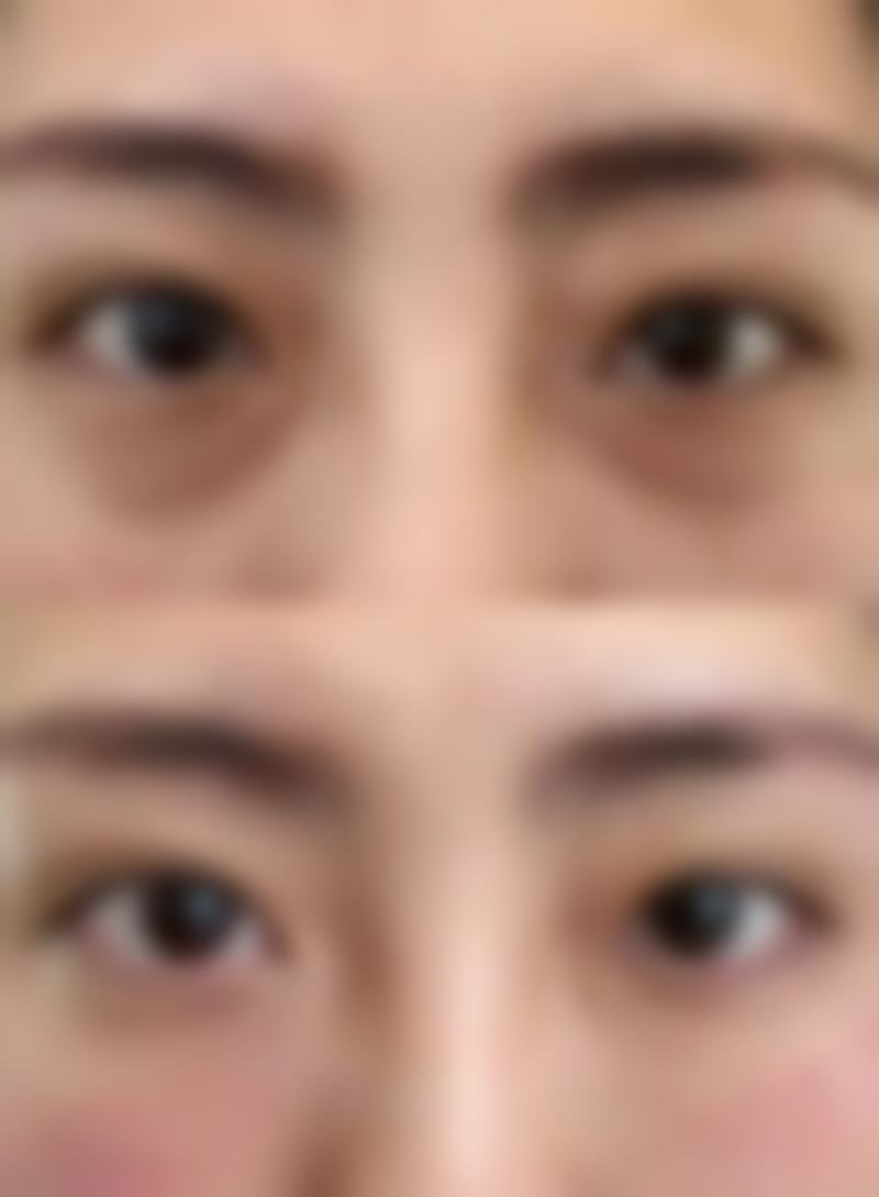 煮鸡蛋去眼袋是否存在副作用