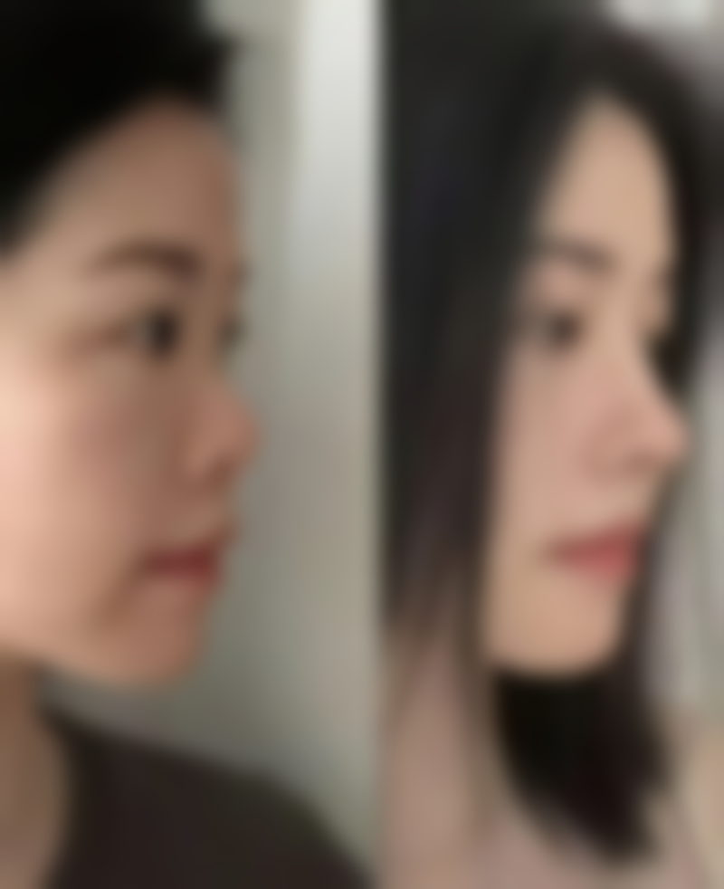 打了瘦脸针可以锻炼吗？24小时后低强度运动，1周恢复健身操