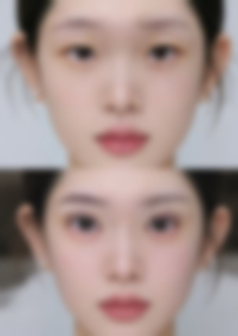 影响提眉和眼袋手术修复时间的因素：体质、手术与护理的综合考量