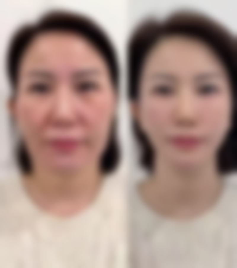 什么牌子瘦脸针更好——从性价比角度分析