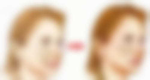 疤痕增生可以恢复吗？激光+药物双管齐下，多年疤痕也能淡化！