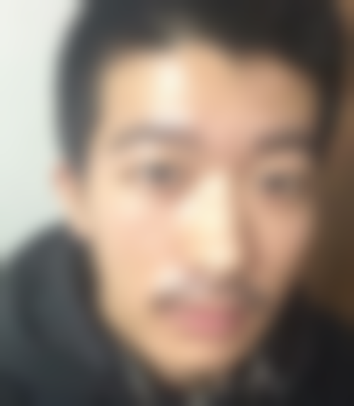 青岛瑧妍美医疗美容医院刘晨涛之皮肤光电治疗真实实例