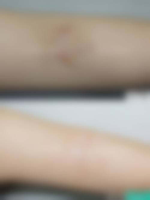 青岛瑧妍美医疗美容医院刘晨涛之激光脱毛惊喜特别优惠