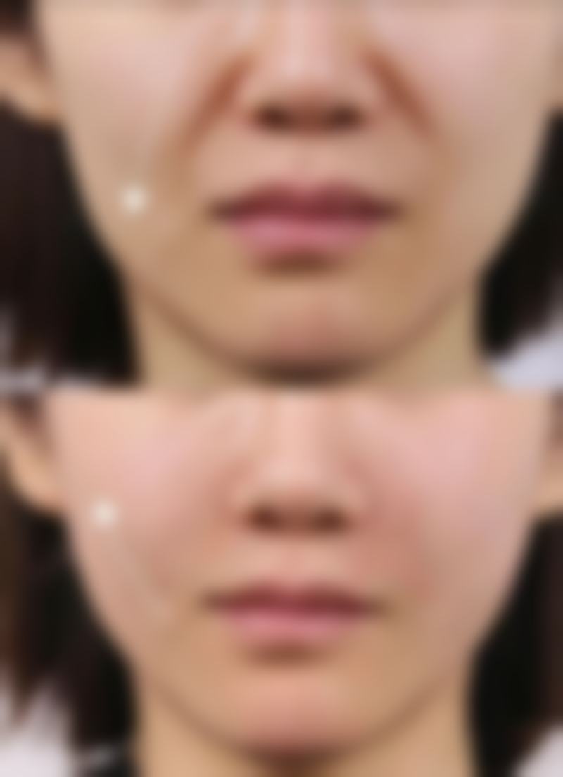 芦荟保湿凝胶可以去除旧疤痕吗——对旧疤痕的功效