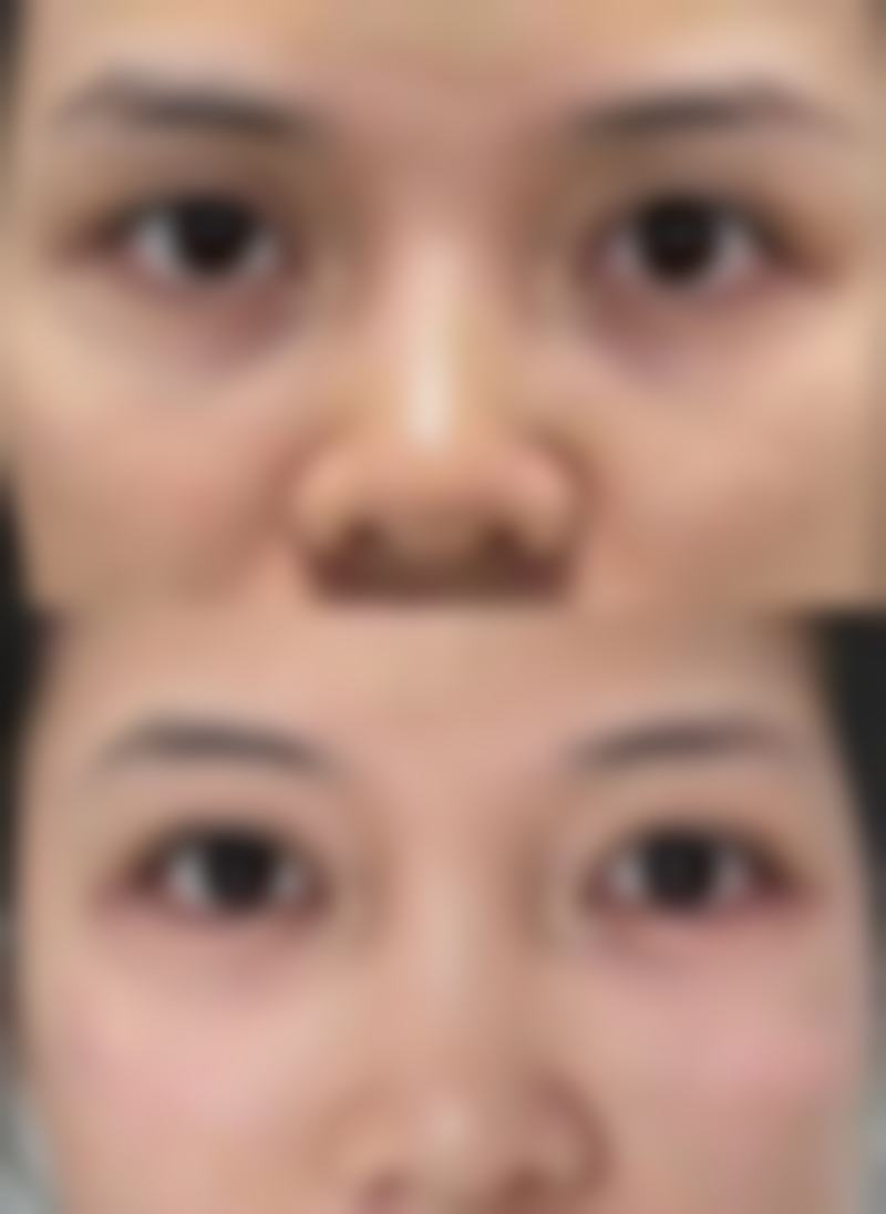 青岛瑧妍美医疗美容医院刘晨涛之面部年轻化惊艳实例