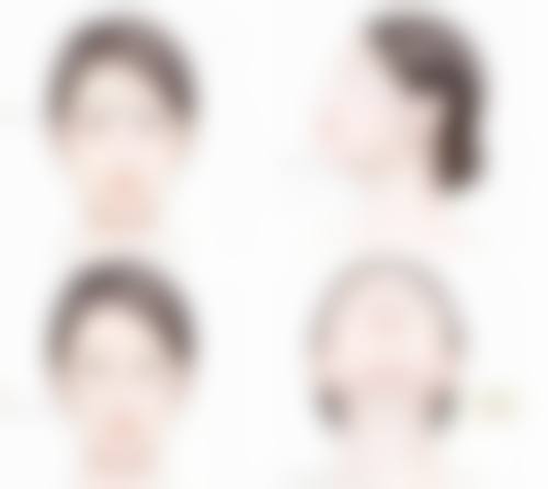 肋软骨隆鼻多久修复——切口修复时间