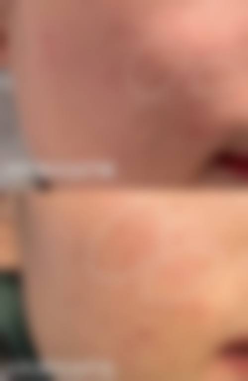 耳软骨隆鼻住院流程：一步步带你走完全过程