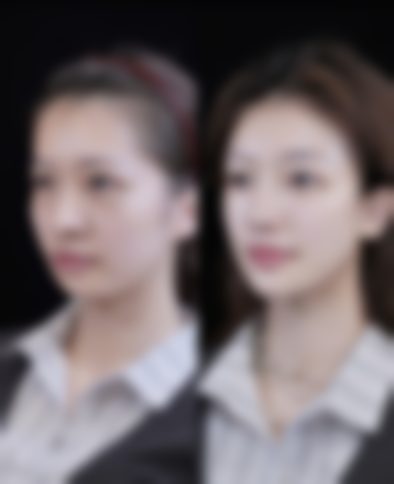 膨体隆鼻假体对人体生物相容性背后的真相