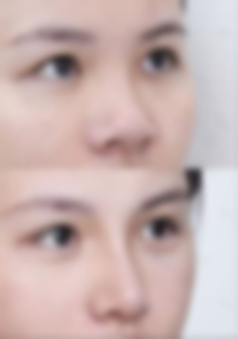 新型隆鼻假体对人体科技带来的安心升级