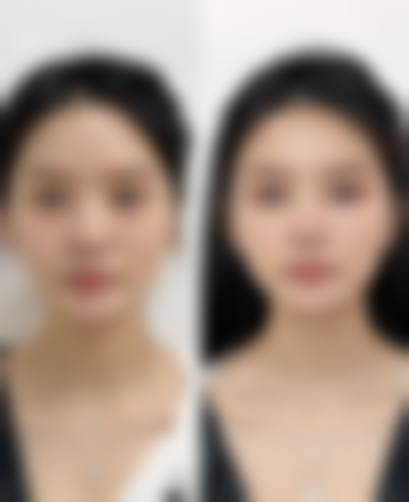 去完眼袋有皱纹怎么办：其他专精解决方案