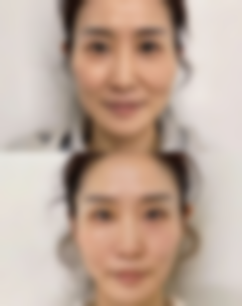 每天眼部按摩能去眼袋吗？15天见效的穴位按摩法+注意事项全解析