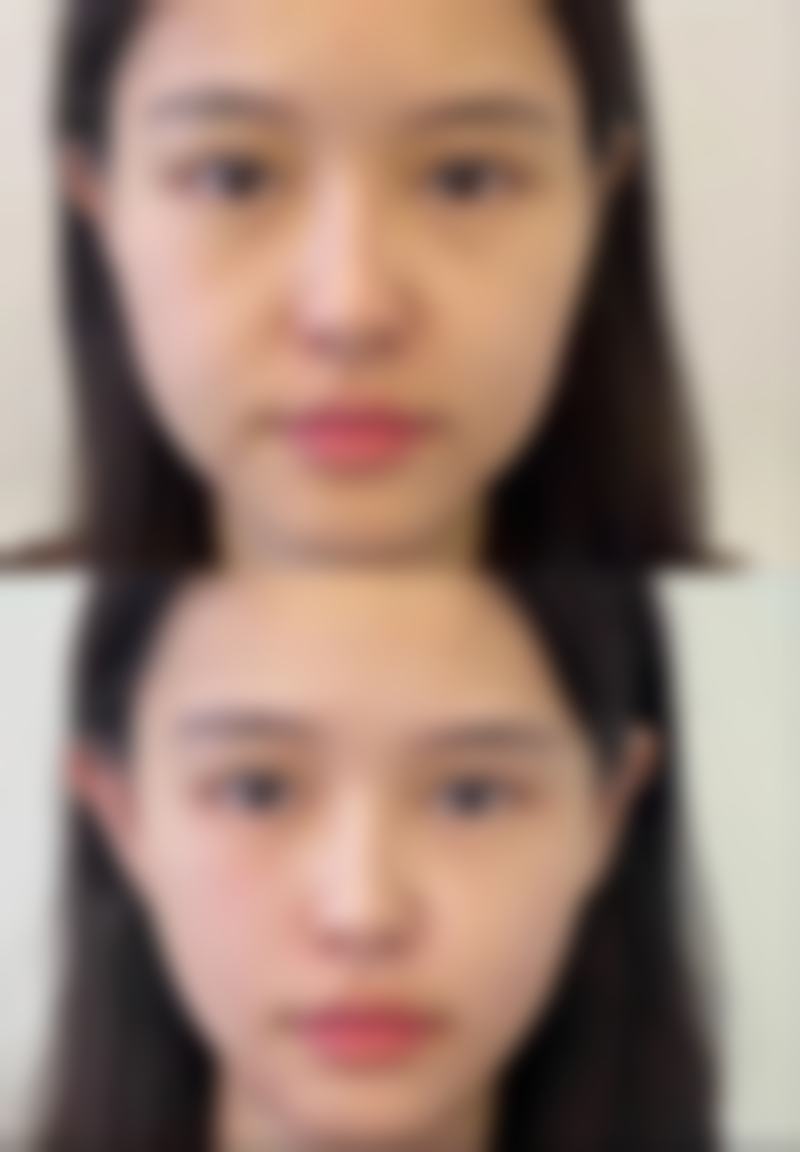 眼袋黑眼圈可以自愈吗——长期顽固派,自查时间红线