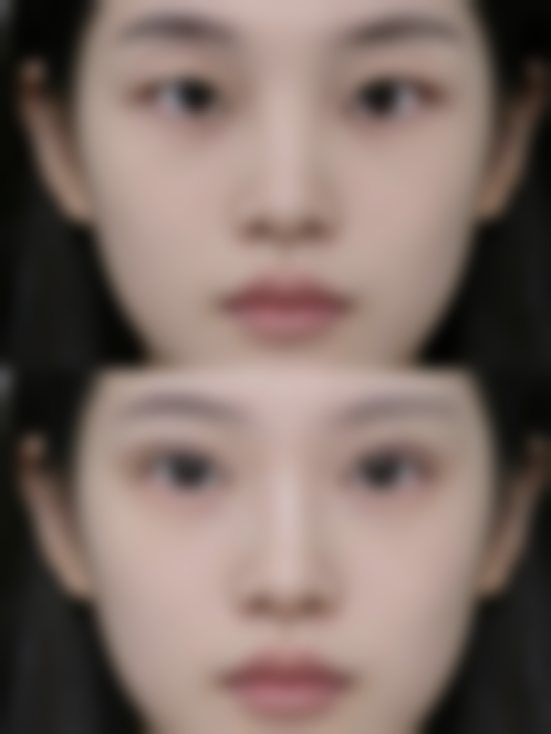 热玛吉眼部除皱安心性论证