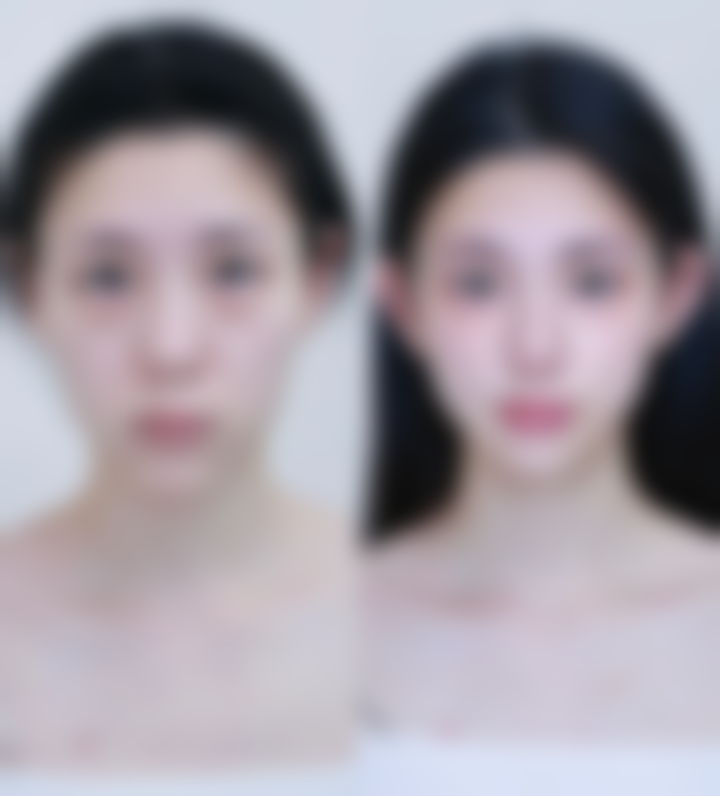 正规医院进行自体脂肪填充眼袋能保持多久