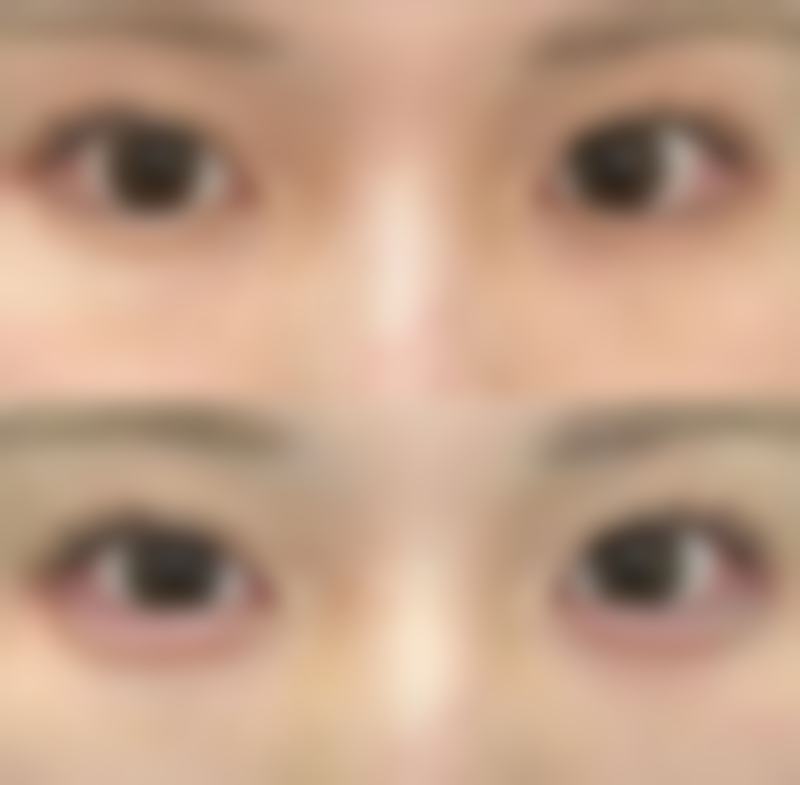 自体脂肪填充眼袋后如何延长保持时间