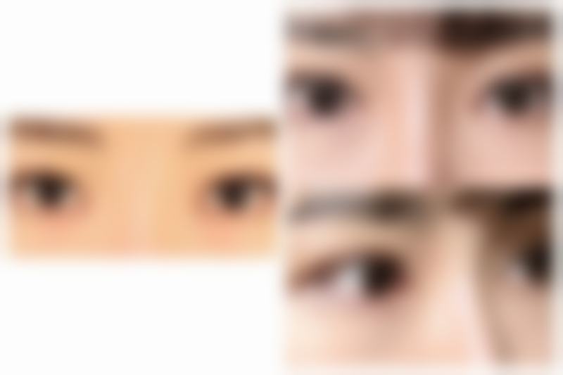 做完双眼皮一个月哭了会导致成效不对称吗