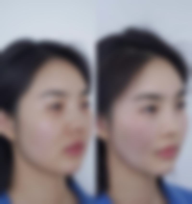 隆鼻哪种是恒久的——膨体隆鼻:理论终身相伴,精心护理是关键