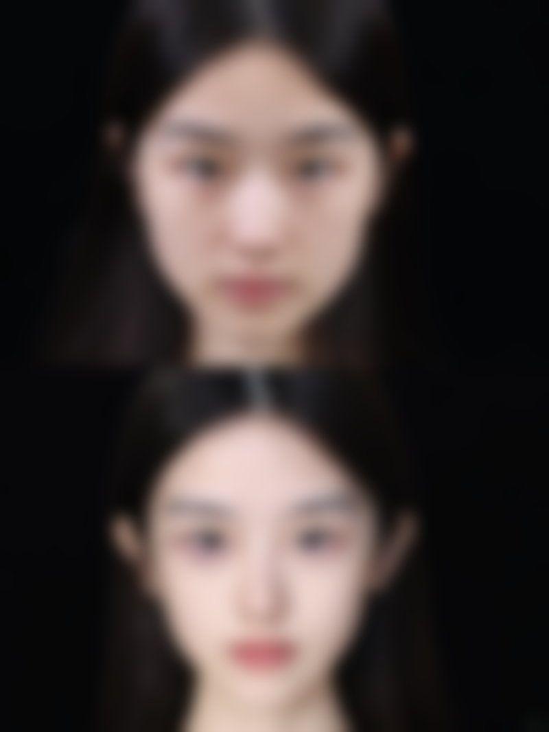 隆鼻哪种是恒久的——注射隆鼻:玻尿酸短期体验,恒久变得更美还需他法