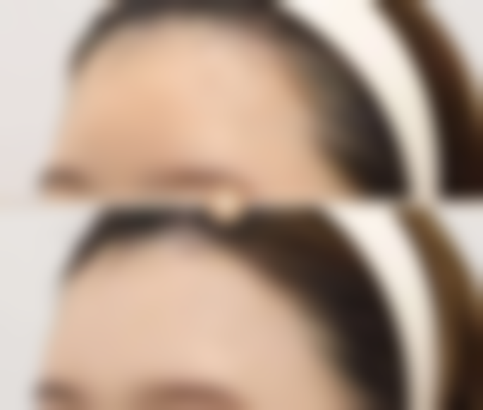 红霉素软膏祛眼袋的注意事项提醒